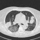 Angioinvasive aspergilosis, second CT: CT - Computed tomography